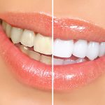 whiten teeth on iphone