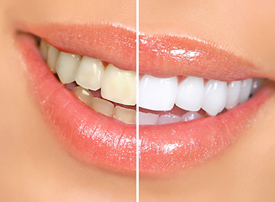 5 apps to whiten teeth on iPhone